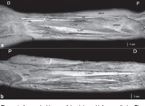 Figure 1 From Bilateral Reversed Palmaris Longus Muscle A Rare