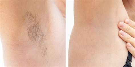 Laser Hair Removal Before And After Underarms Essential Medical Beauty