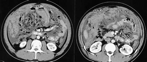 A 25 Year Old Man Proven Primary Distal Ileal Lymphoma With Peritoneal Download Scientific