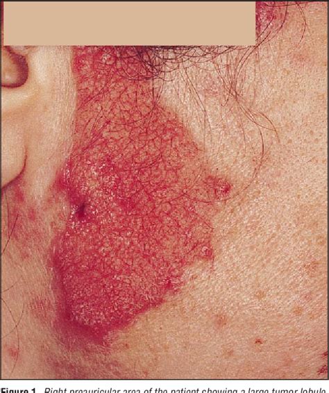 Figure From Photodynamic Therapy For Nevus Sebaceus With Topical Cid