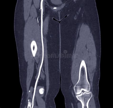 Cta Femoral Artery Run Off Image Of Femoral Artery For Diagnostic Acute