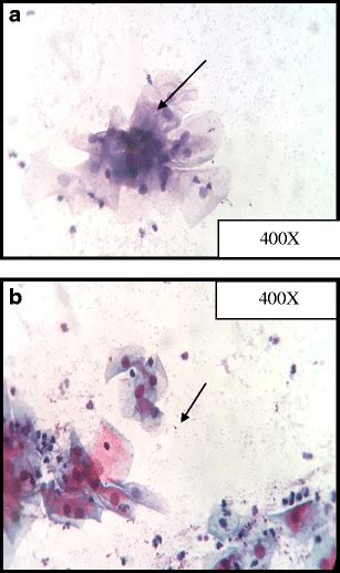 A Conventional Pap Stain— High Power View Showing Candida Download