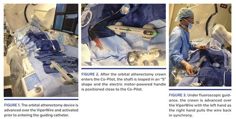 Single Operator Technique For Advancing The Orbital Atherectomy Device