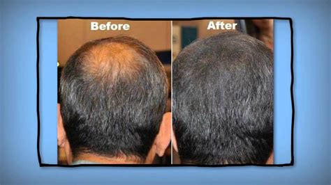 Rx4 Hair Loss Info Abouthairloss