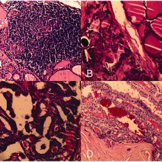 Representative Photomicrographs Of The Tumour Specimen From Case A