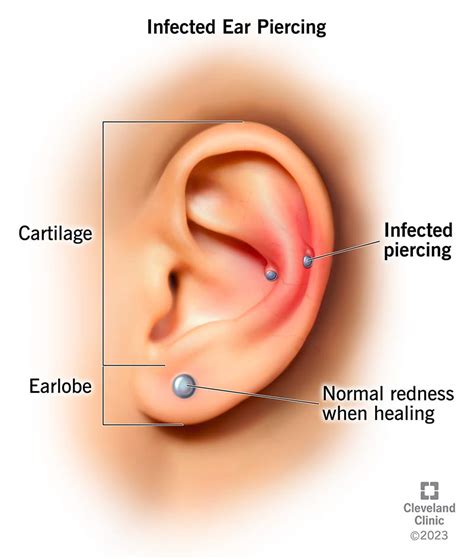 5-7 Days Of Discomfort: What You Need To Know About Ear Piercing Healing