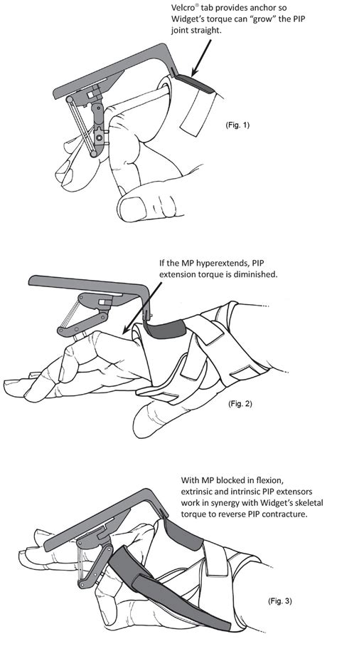 The MP and PIP Joints…how they influence each other - Hand Biomechanics Lab