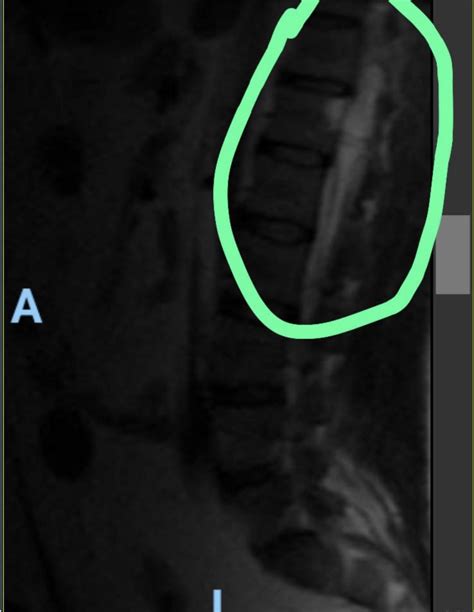 Back cyst : r/SpineSurgery