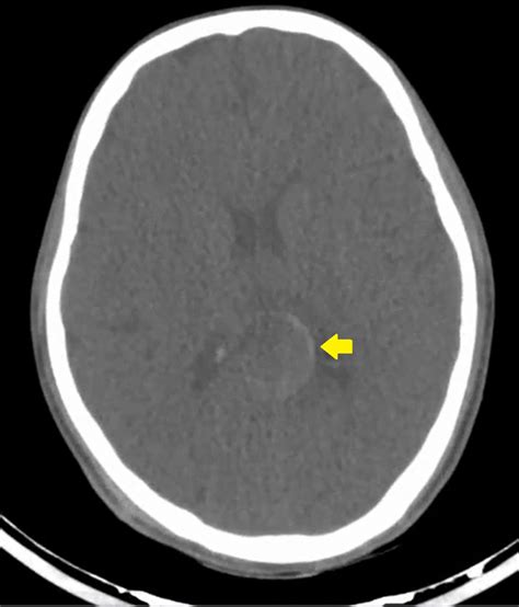 Ring Artefacts In Cranial Ct Bmj Case Reports