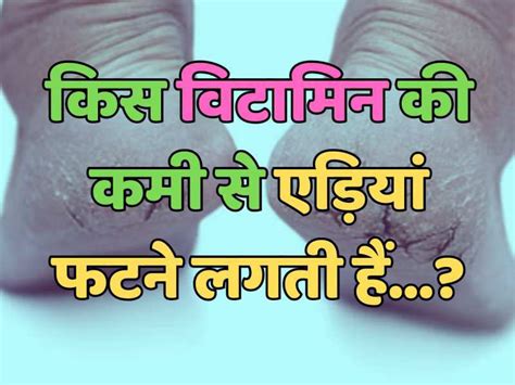 Trending Quiz किस विटामिन की कमी से एड़ियां फटने लगती हैं