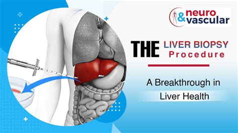 Liver Biopsy Procedure A Breakthrough In Liver Health