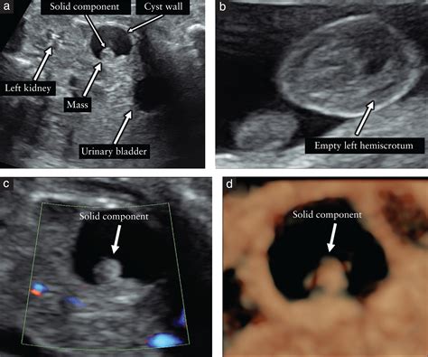 Testicular Teratoma Ultrasound