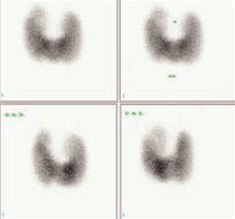 Patients First Thyroid Scan Showing A 52 99m Tc Pertechnetate Uptake