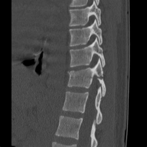 Chance Fracture Radiology Case