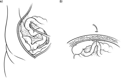 Loop Ileostomy Closure