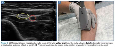 Median Nerve Ultrasound