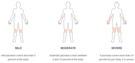 Plaque Psoriasis Causes Treatment Of Moderate To Severe