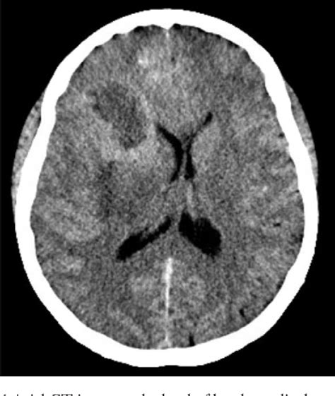 Figure 1 From Advanced Magnetic Resonance Imaging In Glioblastoma A