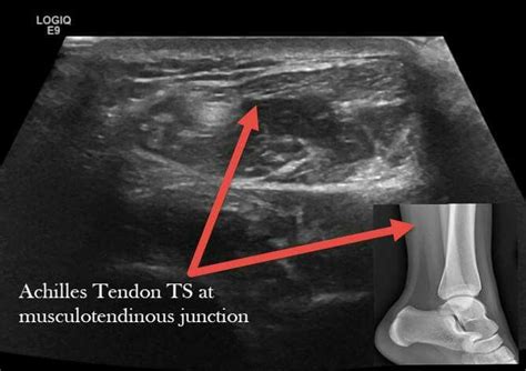 Msk Ultrasound Normal Ankle Posterior Compartment Ultrasound