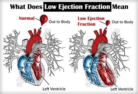 What Is The Normal Lv Ejection Fraction | Natural Resource Department