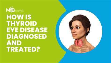 How Is Thyroid Eye Disease Diagnosed And Treated Mb Sciences