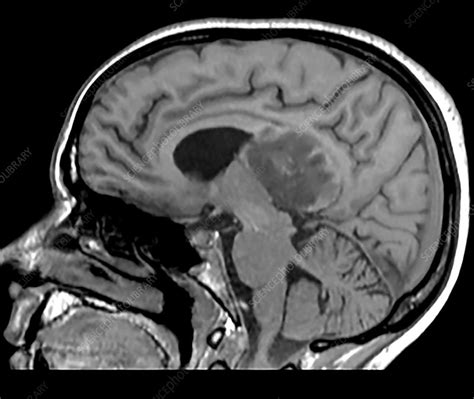 Glioblastoma Mri Stock Image C Science Photo Library