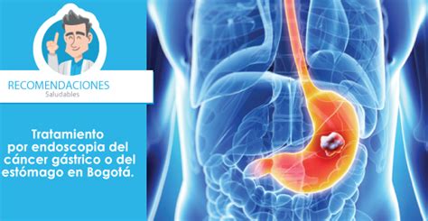 Avances En El Tratamiento Del CÁncer GÁstrico