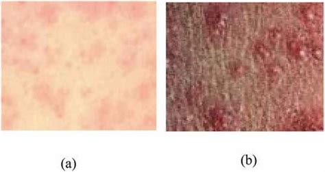 Full Article Machine Learning Approach For Classification Of Maculopapular And Vesicular Rashes