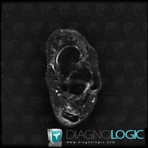 Radiology case : Calcaneal enthesopathy (MRI) - Diagnologic