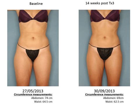 VelaShape III Body Contouring Fresno Mystique Medical Spa