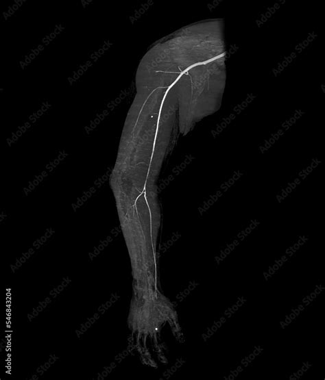 Cta Brachial Artery Or Ct Scan Of Upper Extremity 3d Rendering Image