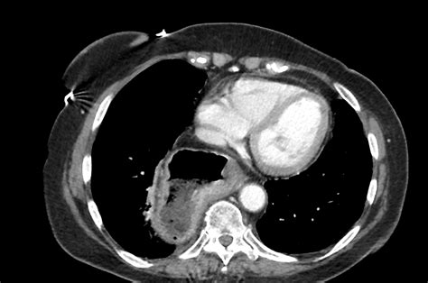 reflux gastro œsophagien Montpellier Dct Salsano Chrirurgie digestive