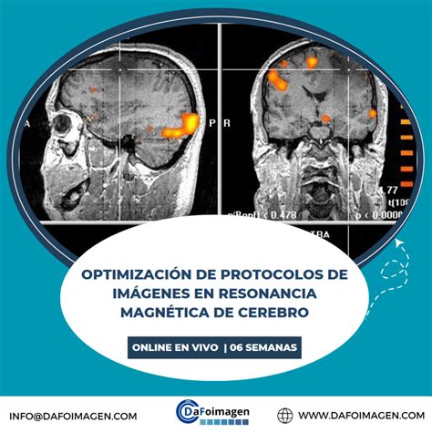 Optimización De Protocolos En Resonancia Magnética Cerebral Dafoimagen