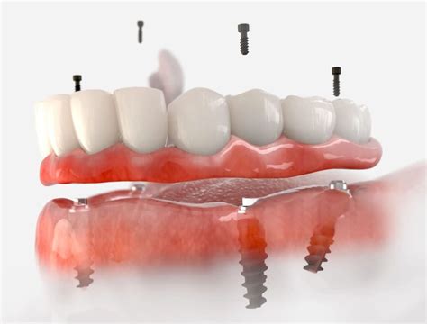 Impianti Dentali All On A Carico Immediato Prezzi