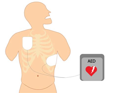 Automated External Defibrillator Pad Placement