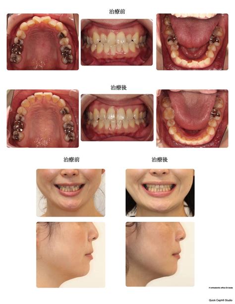 下顎前突症例 ＜叢生を伴う反対咬合に対する非抜歯矯正治療＞ 東京の歯列矯正専門医院 アールエフ矯正歯科