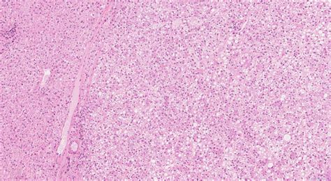 Hepatocellular adenoma | Atlas of Pathology