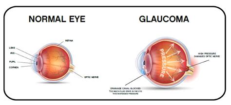 Causas Y Tipos Del Glaucoma Óptica Estaire