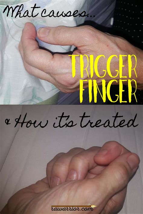 Trigger Finger In Rheumatoid Arthritis Rheumatoid Arthritis Warrior