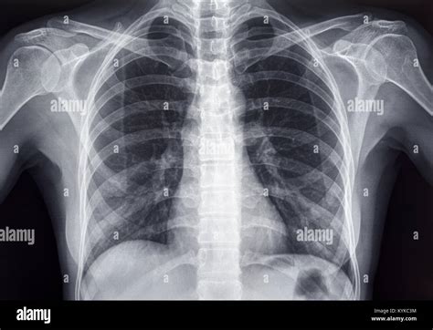 Female Chest X Ray