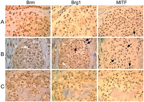 Immunostaining Of Brm Brg And Mitf In Nevi And Primary Melanomas A