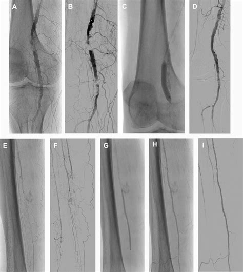 Transradial Access In Interventional Radiology Advances In Clinical Radiology