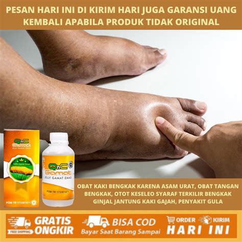 Jual Obat Penumpukan Cairan Di Kaki Edema Obat Kaki Gajah Bengkak