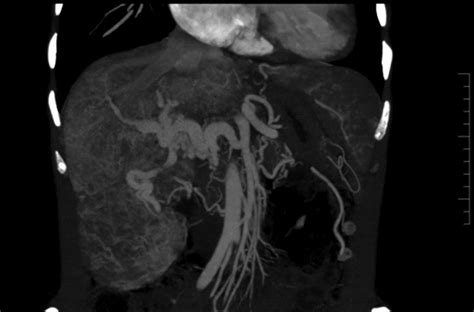 Angiotomografía cortes coronales abdominales Download Scientific