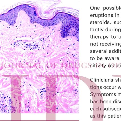 Mild papillary dermal edema and a perivascular and interstital... | Download Scientific Diagram