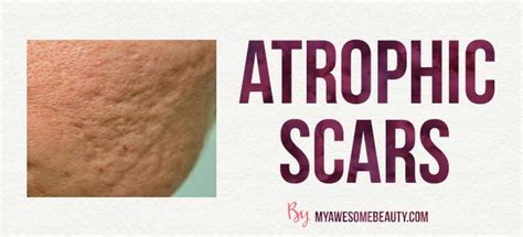 Best Scar Cream Reviews 2020 Comparison And Tips From Experts