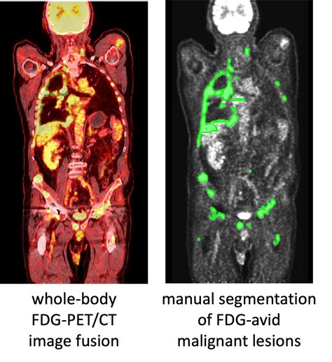 Automated Lesion Segmentation In Whole Body Fdg Pet Ct Challenge