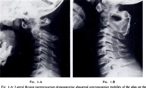 Os odontoideum | Semantic Scholar