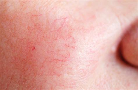 Rosacea Treatment In Singapore A Guide To Managing Skin Redness The