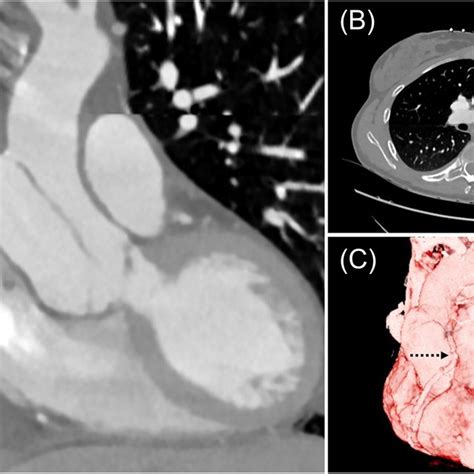 A Angio‐ct Scan Showing Type A Aortic Dissection Limited To The Graft